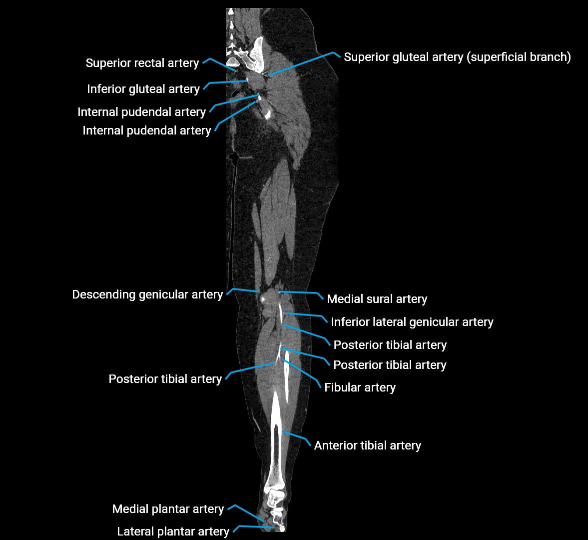 CTA lower limb coronal cross sectional anatomy labelled image _63 (2).webp